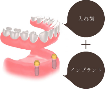 入れ歯+インプラント