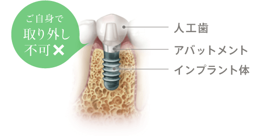 ご自身で取り外し不可