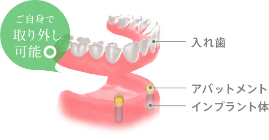 ご自身で取り外し可能