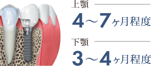 骨が十分にある場合 上顎：4〜7ヶ月程度 下顎：3〜4ヶ月程度