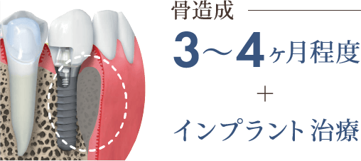 骨が少ない場合 骨構造：3〜4ヶ月程度＋インプラント治療