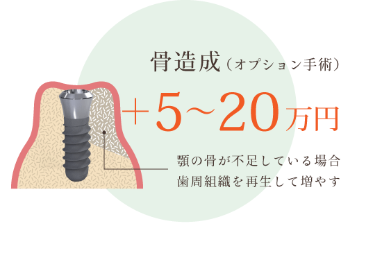 骨造成（オプション手術） ＋5〜20万円 顎の骨が不足している場合歯周組織を再生して増やす